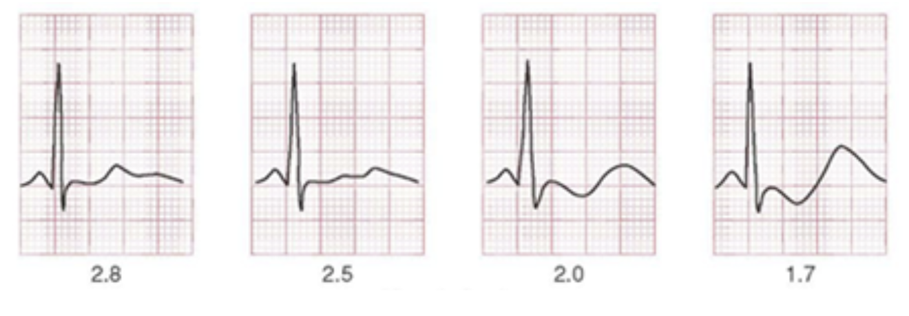 Hypokalaemia